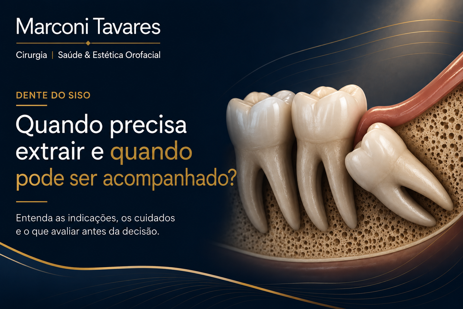 Terceiros molares (sisos): avaliação e planejamento para extração dos dentes do siso